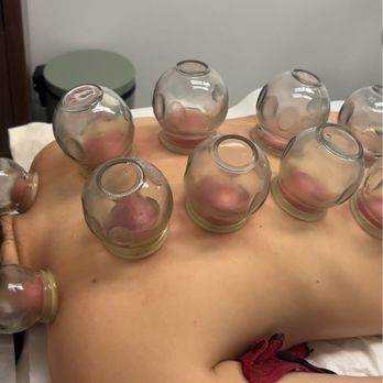 Root & Shen Wellness - Cupping therapy for back pain, workout recovery - Acupuncture Near Me - Torrance, California Root & Shen Wellness - Cupping therapy for back pain, workout recovery - Acupuncture Near Me - Torrance, California
