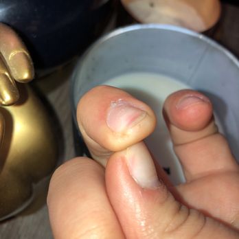 World Nail Spa - Cut finger with product built up in cuticles - Nail Salons Near Me - Champaign, Illinois