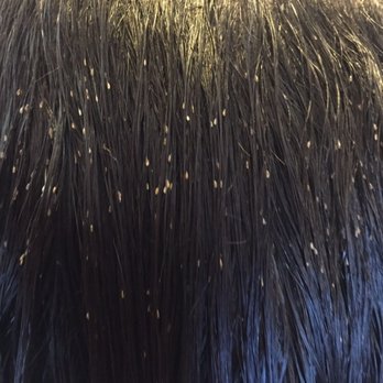Head Lice Guru - This poor girl had lice for years. It took 2 hours and a follow up to get all the critters out! - Lice Services Near Me Head Lice Guru - This poor girl had lice for years. It took 2 hours and a follow up to get all the critters out! - Lice Services Near Me