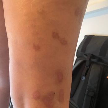 Front Door Medspa - Current state of one of my legs. - Skin Care Near Me - Rochester, Michigan