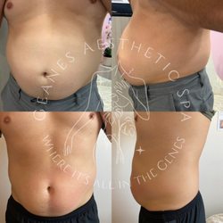 Geanes Aesthetic Spa - Cryo body sculpting and contouring