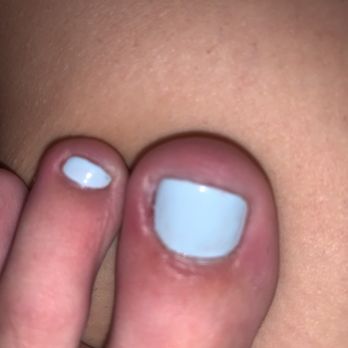 PUR Nail Spa - Infected after getting pedicure done - Nail Salons Near Me - Indianapolis, Indiana PUR Nail Spa - Infected after getting pedicure done - Nail Salons Near Me - Indianapolis, Indiana