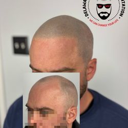 Delaware Scalp Micropigmentation - Get your hairline back! you have nothing to lose! Free Consultation!