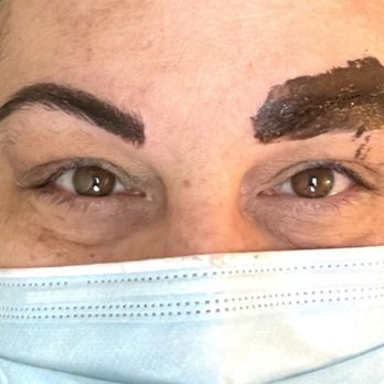 Tollgate Aesthetics - During: my brows after the second pass. One side done and the other with the color seeping into my eyebrow - A woman with brown eyes and dark eyebrows is wearing a face mask. Her eyebrows are being tattooed or colored, with one side completed and the other in progress. - Laser Hair Removal Near Me - Warwick, Rhode Island