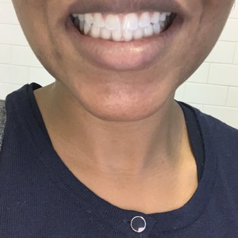 Manhattan Bridge Orthodontics - After an amazing year with MBO - Orthodontists Near Me - New York, New York Manhattan Bridge Orthodontics - After an amazing year with MBO - Orthodontists Near Me - New York, New York