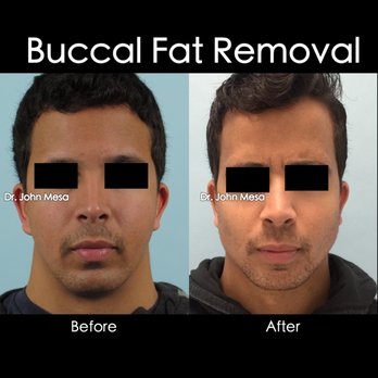 John Mesa - Buccal Fat Removal and Cheek Fillers - Cosmetic Surgeons Near Me - Manhattan, New York John Mesa - Buccal Fat Removal and Cheek Fillers - Cosmetic Surgeons Near Me - Manhattan, New York