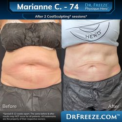 Dr. Freeze CoolSculpting Center - Marianne after 2 CoolSculpting sessions!