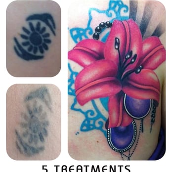Second Skin Laser - Second Skin Tattoo Removal | Edmonton - Skin Care Near Me - Edmonton, Alberta Second Skin Laser - Second Skin Tattoo Removal | Edmonton - Skin Care Near Me - Edmonton, Alberta