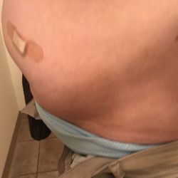 Sentara Albemarle Medical Center - Elizabeth City - Distended stomach NOT notated in medical records