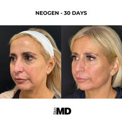 SkinMD Peabody - NeoGen. The ultimate in skin rejuvenation and skin tightening!