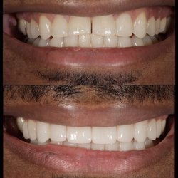 Mark Kuioka, DDS - 20 porcelain veneers to improve color and bite function.