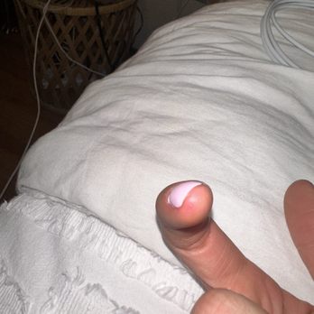 Teresa's Nails - Swollen finger - Nail Salons Near Me - Carmichael, California Teresa's Nails - Swollen finger - Nail Salons Near Me - Carmichael, California