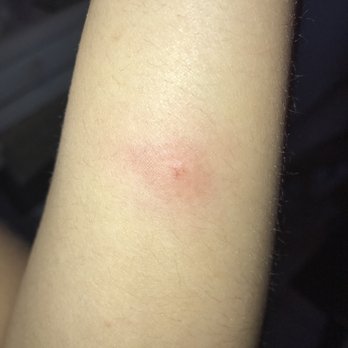 Janko Property Management - Bed bug bite - Property Management Near Me - Oak Park, Illinois Janko Property Management - Bed bug bite - Property Management Near Me - Oak Park, Illinois