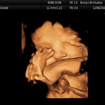 Bump Life 4D Ultrasound Studio - Trying to cover his face - Ultrasound Imaging Centers Near Me - Madison, Alabama Bump Life 4D Ultrasound Studio - Trying to cover his face - Ultrasound Imaging Centers Near Me - Madison, Alabama