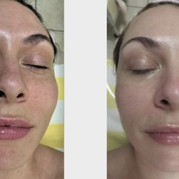 Before and after sunspot and skin tag removal. The texture of my skin is so much smoother and my fine lines are gone. Before and after sunspot and skin tag removal. The texture of my skin is so much smoother and my fine lines are gone.