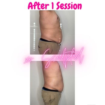 Xo Sculpted - Body Contouring Near Me Xo Sculpted - Body Contouring Near Me