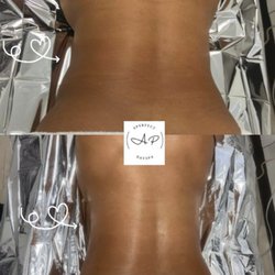 A Perfect Day Spa - Before and After Her first session Metal Therapy Benefits *Slims the body *Reduces inflammation *Lymphatic drainage *Tones and Tightens