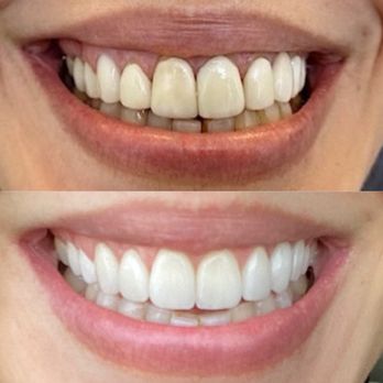 Shervin M. Louie, DDS - Before and After. 9 top veneers/crowns + 1 implant crown, and bottom teeth whitening. - Cosmetic Dentists Near Me - Los Angeles, California Shervin M. Louie, DDS - Before and After. 9 top veneers/crowns + 1 implant crown, and bottom teeth whitening. - Cosmetic Dentists Near Me - Los Angeles, California