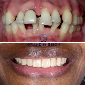 Grand Mission Dentistry Of Richmond - combination of orthodontics, dental implants, and porcelain restorations used - General Dentistry Near Me - Richmond, Texas Grand Mission Dentistry Of Richmond - combination of orthodontics, dental implants, and porcelain restorations used - General Dentistry Near Me - Richmond, Texas