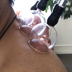 The People's Acupuncture Clinic Inc. - Cup treatment