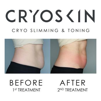 ClubCryo - CryoSlimming results after 2 sessions - Cryotherapy Near Me - Arlington, Texas ClubCryo - CryoSlimming results after 2 sessions - Cryotherapy Near Me - Arlington, Texas