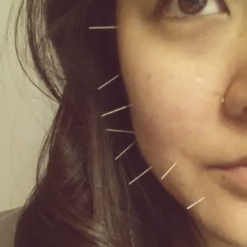 Rx Bodyworks - Cosmetic acupuncture in the works. 30 going on 18 :) - Chiropractors Near Me - Thousand Oaks, California