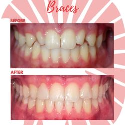 Hawaii Orthodontist - Before and after with peg shaped laterals, patient had cosmetic bonding completed at end of treatment