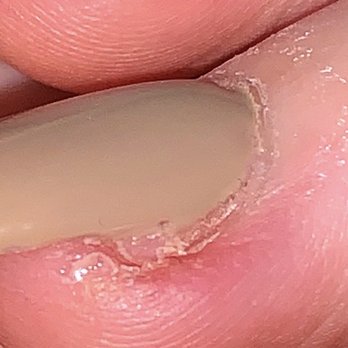 Ann Nails - She didn't quite cover the damage here, you can see how my natural nail is essentially gone underneath. - Nail Salons Near Me - Avondale, Arizona