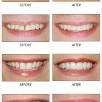 Big Dental Group - Lumineers - Cosmetic Dentists Near Me - Huntington Beach, California Big Dental Group - Lumineers - Cosmetic Dentists Near Me - Huntington Beach, California
