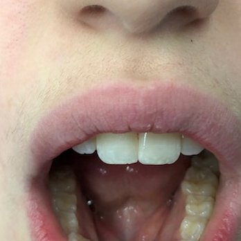 Capital Kids Dentistry - AFTER: See Dr. Jessica's FLAWLESS and STUNNING work. - Pediatric Dentists Near Me - Washington, DC, District of Columbia Capital Kids Dentistry - AFTER: See Dr. Jessica's FLAWLESS and STUNNING work. - Pediatric Dentists Near Me - Washington, DC, District of Columbia