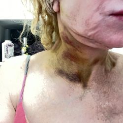 Raja Srour, MD - Huge blood clot that I was told to wait 4 days for the body to absorb.  Jowls and loose skin.  No face lift