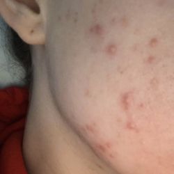 Gould-Jacobson Dermatology - How is this skin bad enough to go on accutane?