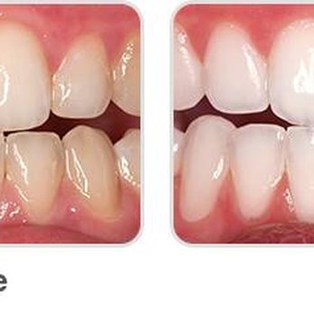 Tansbourne Dental Care - Before and After bleaching - General Dentistry Near Me - Hillsboro, Oregon Tansbourne Dental Care - Before and After bleaching - General Dentistry Near Me - Hillsboro, Oregon