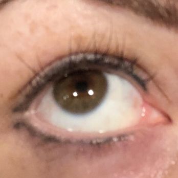 Lush Beauty - After 5 days - Skin Care Near Me - Dallas, Texas Lush Beauty - After 5 days - Skin Care Near Me - Dallas, Texas