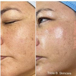 Glowing skin after Microdermabrasion and a chemical peel!