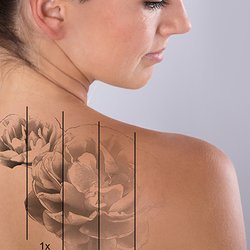 Zahn Aesthetic & Laser Services - Tattoo Removal