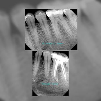 Passyunk Dental Group - Molar root canal in one visit. - General Dentistry Near Me - Philadelphia, Pennsylvania Passyunk Dental Group - Molar root canal in one visit. - General Dentistry Near Me - Philadelphia, Pennsylvania