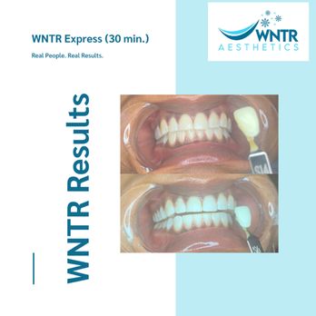 WNTR Aesthetics - Before and after results from the WNTR White service. - Teeth Whitening Near Me - Durham, North Carolina WNTR Aesthetics - Before and after results from the WNTR White service. - Teeth Whitening Near Me - Durham, North Carolina
