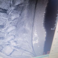 Northwest Arkansas Neuroscience Institute - Was told nothing else they could do for spine told me not to uams in little rock arkansas that's 4 hour drive