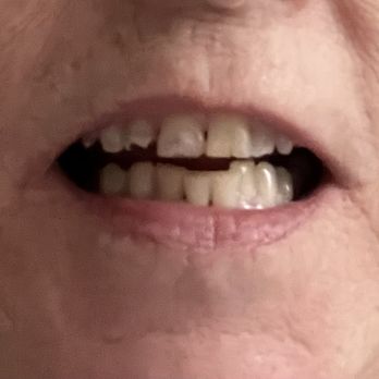 Innovative Smiles - Before - General Dentistry Near Me - Cerritos, California