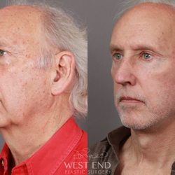 Paul G Ruff IV, MD FACS - Dr. Ruff performed a Deep Plane Facelift & Neck Lift, Eyelid Lift, Fat Grafting, and CO2 Resurfacing. The patient is 5 Months Post-Op.