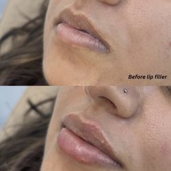 Nür Aesthetics Club - Lip filler with restylane Kysse