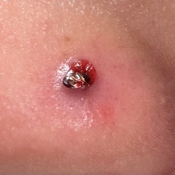 Nebu Piercings - After Priscilla tried taking the piercing out - Piercing Near Me - Pacifica, California Nebu Piercings - After Priscilla tried taking the piercing out - Piercing Near Me - Pacifica, California