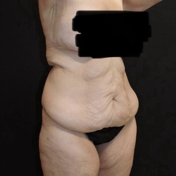 Napa Solano Plastic Surgery - Before - Plastic Surgeons Near Me - Vacaville, California Napa Solano Plastic Surgery - Before - Plastic Surgeons Near Me - Vacaville, California