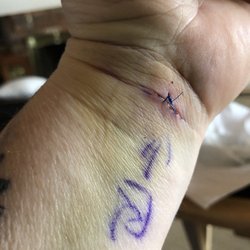 UBMD Orthopaedics & Sports Medicine - Still quite bruised and sore