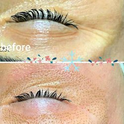 T-Beauty Lounge - Fibroblasts