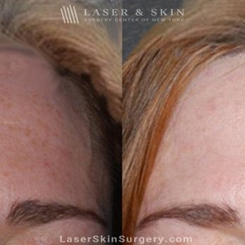 Laser & Skin - Botox Injections for Forehead Wrinkles - Dermatologists Near Me - Devon, Pennsylvania