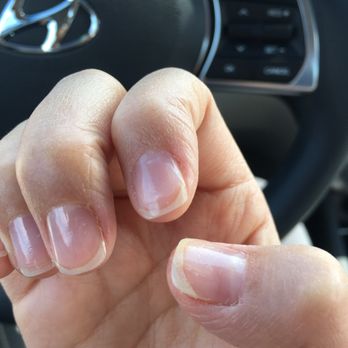 Nail Essence Salon & Spa - Thumb and index fingernails had obvious cracks and divots. The top layer peeled off from the gel removing process - Nail Salons Near Me - Morton Grove, Illinois Nail Essence Salon & Spa - Thumb and index fingernails had obvious cracks and divots. The top layer peeled off from the gel removing process - Nail Salons Near Me - Morton Grove, Illinois