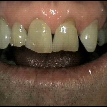 Mark A Barber, DDS - This case involved older, dark teeth, multiple chips, and a missing front left tooth. - General Dentistry Near Me - Port St Lucie, Florida Mark A Barber, DDS - This case involved older, dark teeth, multiple chips, and a missing front left tooth. - General Dentistry Near Me - Port St Lucie, Florida