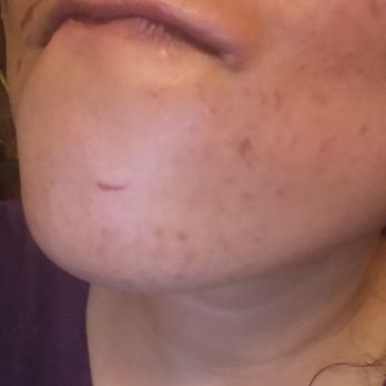 Ideal Salon - Burn marks from face wax!! - Waxing Near Me - Chicago, Illinois Ideal Salon - Burn marks from face wax!! - Waxing Near Me - Chicago, Illinois